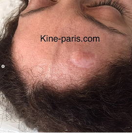 Cicatrice sur scalpe frontal après